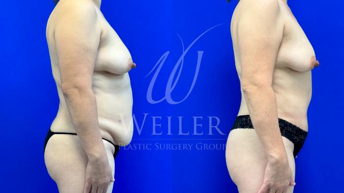 Before & After Tummy Tuck Case 1261 Left Side View in Baton Rouge, New Orleans, & Lafayette, Louisiana