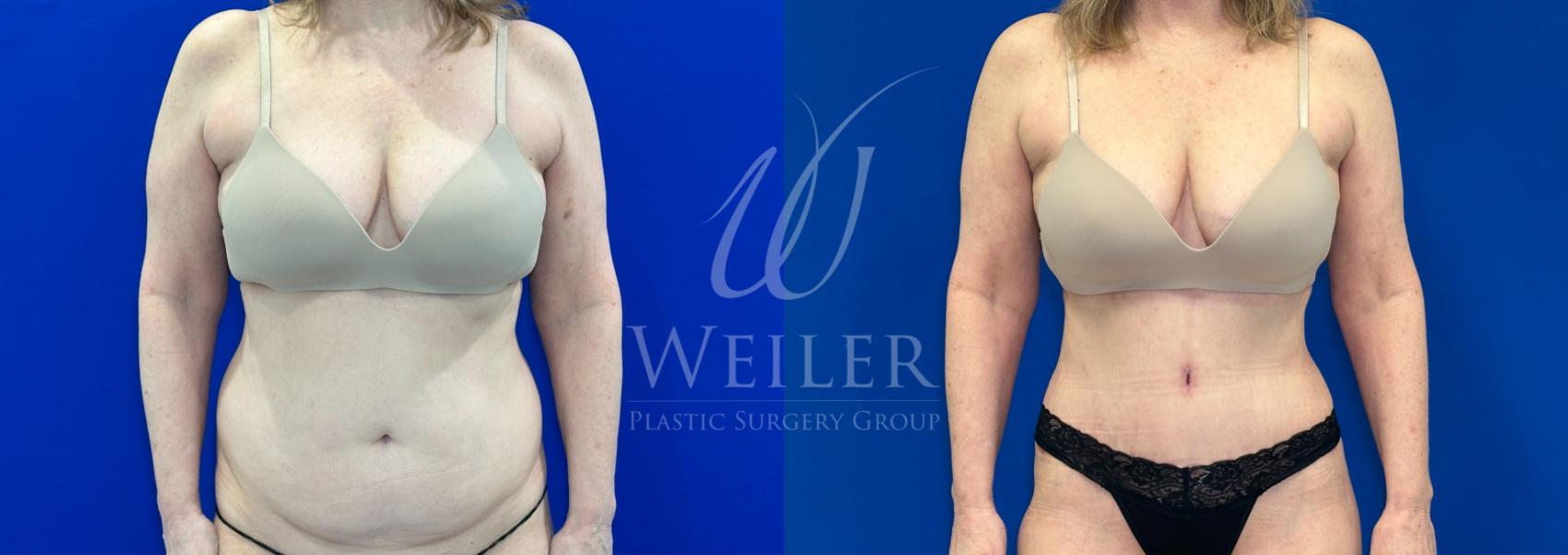 Before & After Tummy Tuck Case 1298 Front View in Baton Rouge, New Orleans, & Lafayette, Louisiana