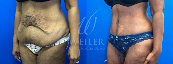 Before & After Tummy Tuck Case 1316 Left Oblique View in Baton Rouge, New Orleans, & Lafayette, Louisiana