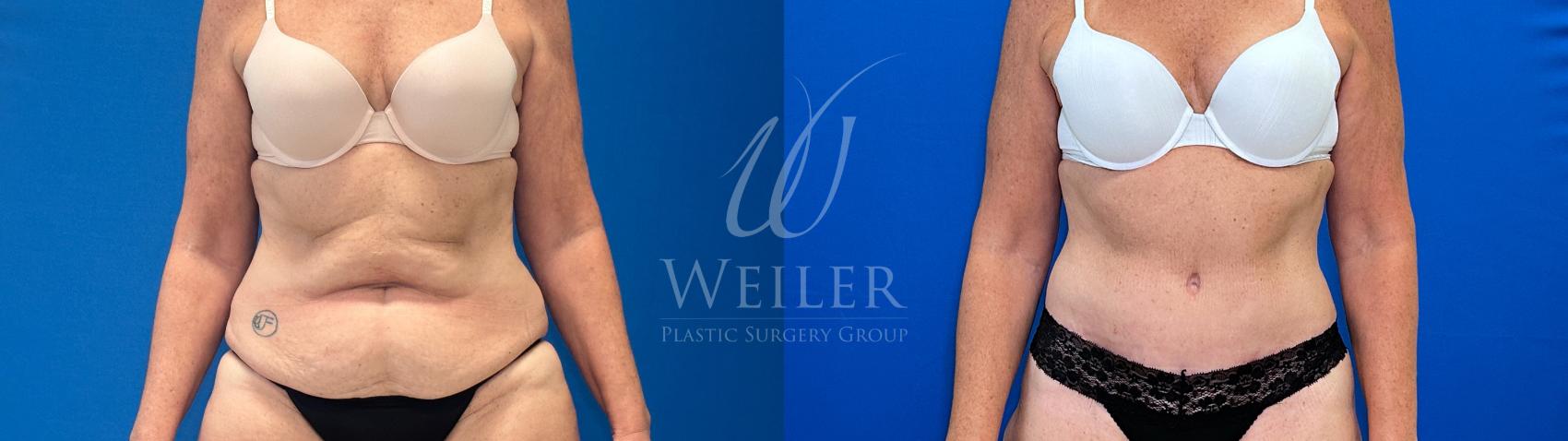 Before & After Tummy Tuck Case 1332 Front View in Baton Rouge, New Orleans, & Lafayette, Louisiana