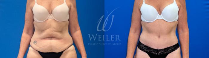 Before & After Tummy Tuck Case 1332 Front View in Baton Rouge, New Orleans, & Lafayette, Louisiana
