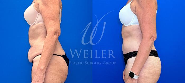 Before & After Tummy Tuck Case 1332 Left Side View in Baton Rouge, New Orleans, & Lafayette, Louisiana