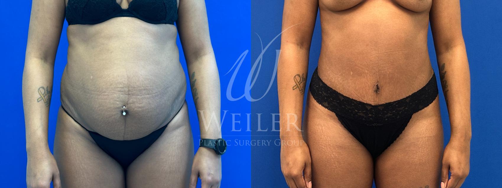 Before & After Tummy Tuck Case 1360 Front View in Baton Rouge, New Orleans, & Lafayette, Louisiana