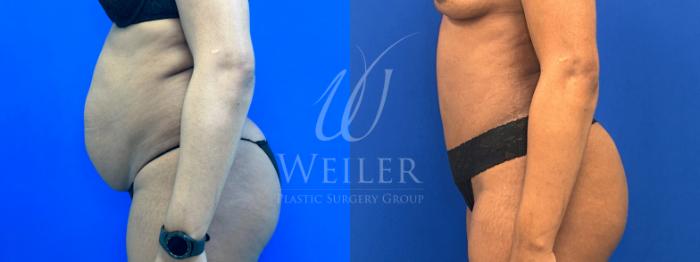 Before & After Tummy Tuck Case 1360 Left Side View in Baton Rouge, New Orleans, & Lafayette, Louisiana