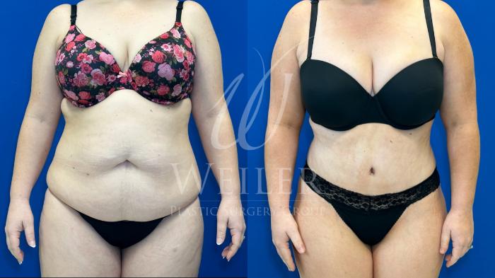 Before & After Tummy Tuck Case 1362 Front View in Baton Rouge, New Orleans, & Lafayette, Louisiana