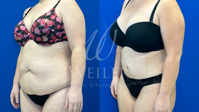 Before & After Tummy Tuck Case 1362 Right Oblique View in Baton Rouge, New Orleans, & Lafayette, Louisiana