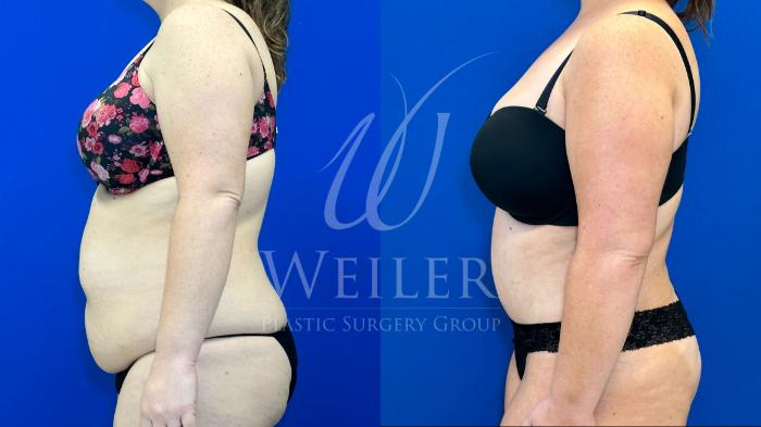 Before & After Tummy Tuck Case 1362 Right Side View in Baton Rouge, New Orleans, & Lafayette, Louisiana