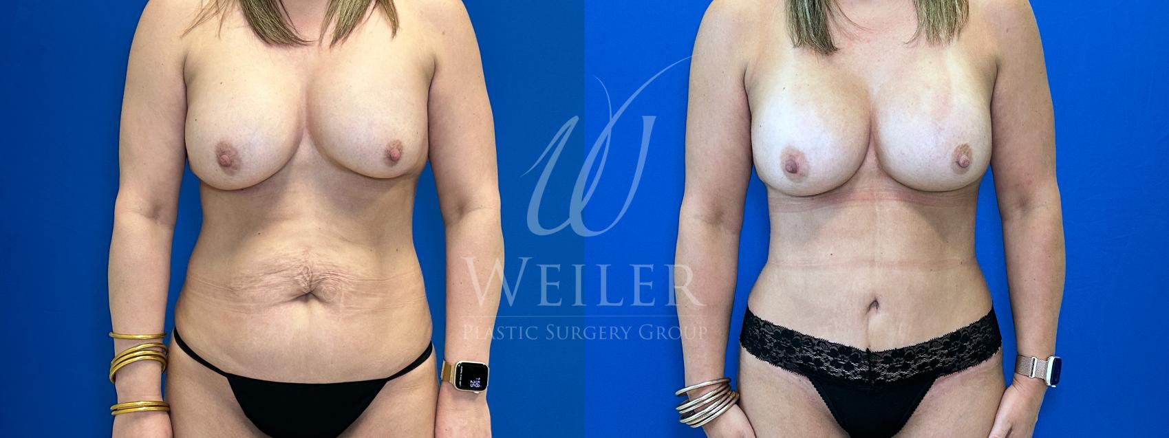 Before & After Tummy Tuck Case 1375 Front View in Baton Rouge, New Orleans, & Lafayette, Louisiana