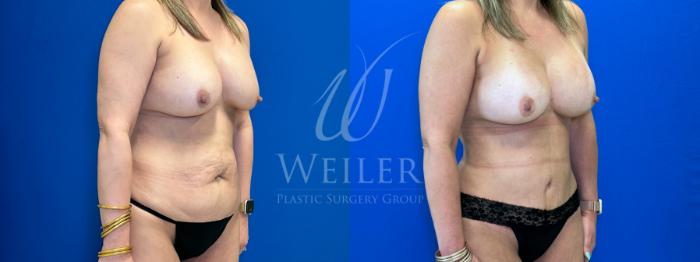 Before & After Tummy Tuck Case 1375 Right Oblique View in Baton Rouge, New Orleans, & Lafayette, Louisiana