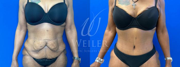 Before & After Tummy Tuck Case 1378 Front View in Baton Rouge, New Orleans, & Lafayette, Louisiana