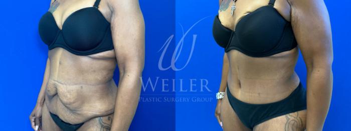 Before & After Tummy Tuck Case 1378 Left Oblique View in Baton Rouge, New Orleans, & Lafayette, Louisiana