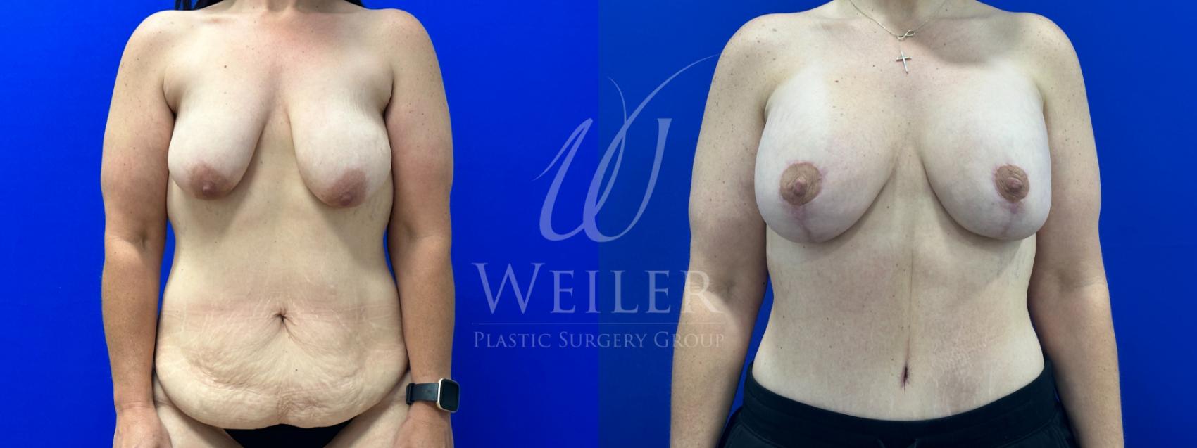 Before & After Tummy Tuck Case 1380 Front View in Baton Rouge, New Orleans, & Lafayette, Louisiana