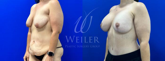 Before & After Tummy Tuck Case 1380 Left Oblique View in Baton Rouge, New Orleans, & Lafayette, Louisiana