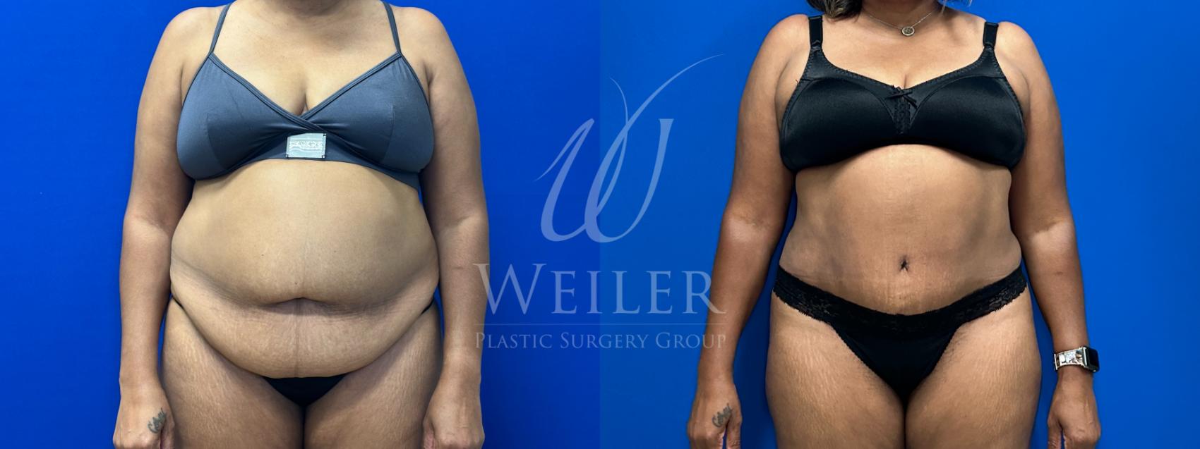 Before & After Tummy Tuck Case 1396 Front View in Baton Rouge, New Orleans, & Lafayette, Louisiana