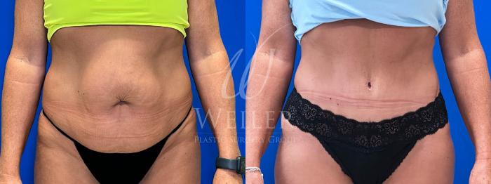 Before & After Tummy Tuck Case 1400 Front View in Baton Rouge, New Orleans, & Lafayette, Louisiana