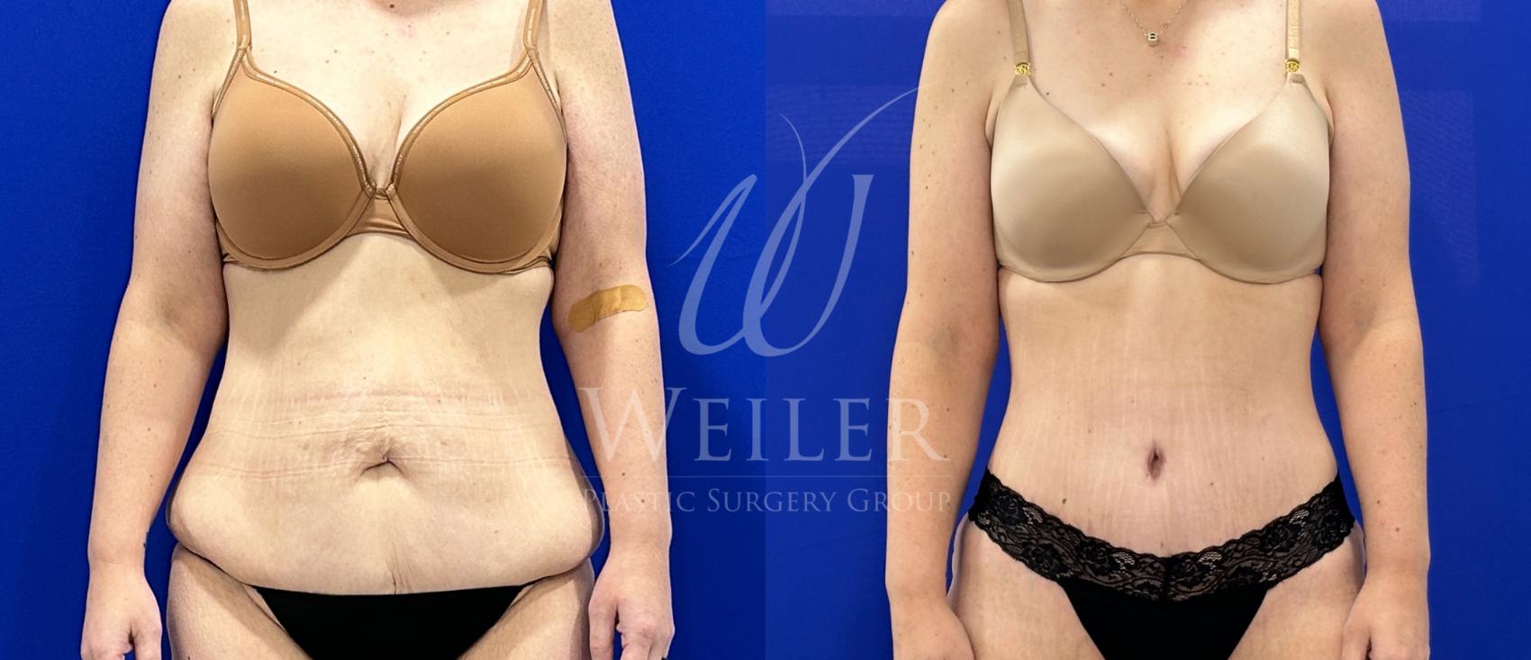 Before & After Tummy Tuck Case 1404 Front View in Baton Rouge, New Orleans, & Lafayette, Louisiana