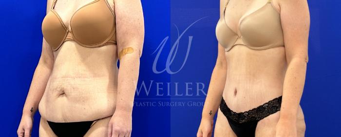 Before & After Tummy Tuck Case 1404 Left Oblique View in Baton Rouge, New Orleans, & Lafayette, Louisiana