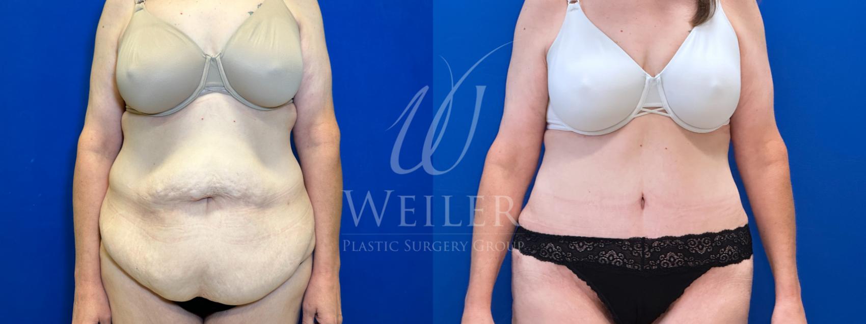 Before & After Tummy Tuck Case 1407 Front View in Baton Rouge, New Orleans, & Lafayette, Louisiana