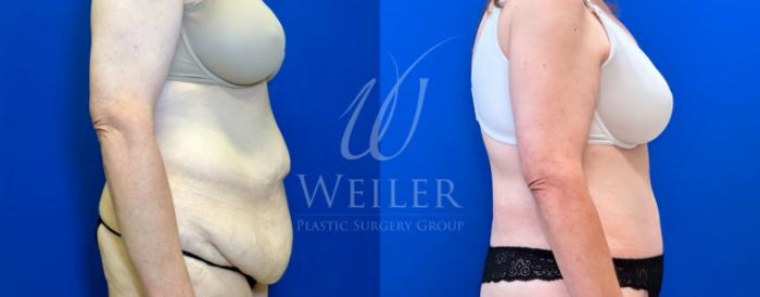 Before & After Tummy Tuck Case 1407 Right Side View in Baton Rouge, New Orleans, & Lafayette, Louisiana