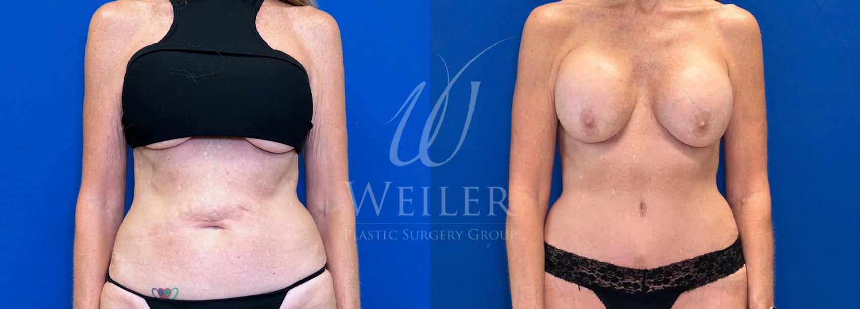 Before & After Tummy Tuck Case 1443 Front View in Baton Rouge, New Orleans, & Lafayette, Louisiana