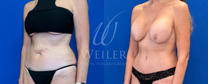 Before & After Tummy Tuck Case 1443 Left Oblique View in Baton Rouge, New Orleans, & Lafayette, Louisiana