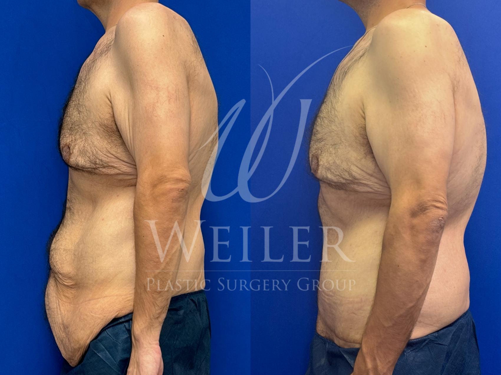 Before & After Tummy Tuck Case 1500 Left Side View in Baton Rouge, New Orleans, & Lafayette, Louisiana