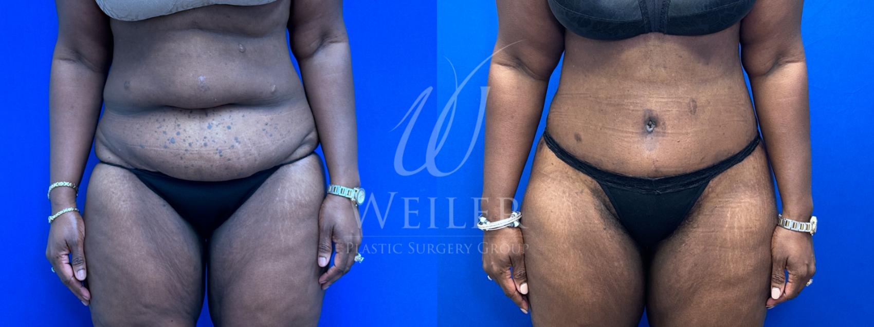 Before & After Tummy Tuck Case 1502 Front View in Baton Rouge, New Orleans, & Lafayette, Louisiana