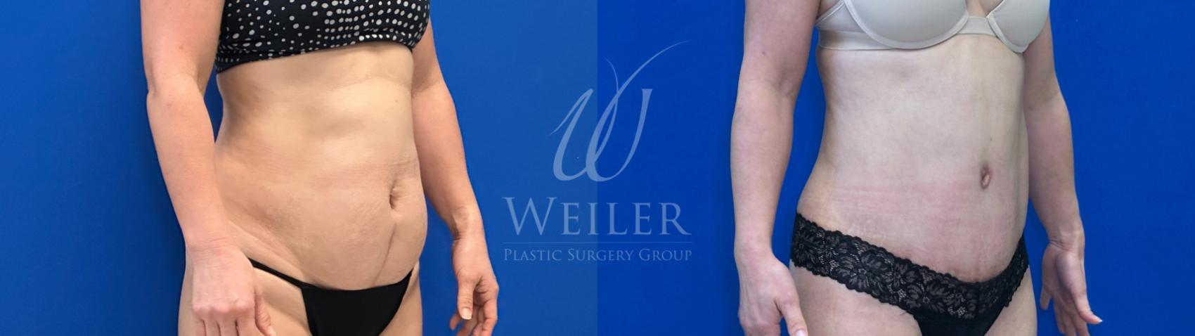 Before & After Liposuction Case 1527 Right Oblique View in Baton Rouge, New Orleans, & Lafayette, Louisiana