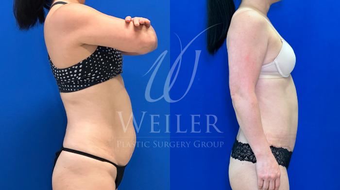 Before & After Liposuction Case 1527 Right Side View in Baton Rouge, New Orleans, & Lafayette, Louisiana