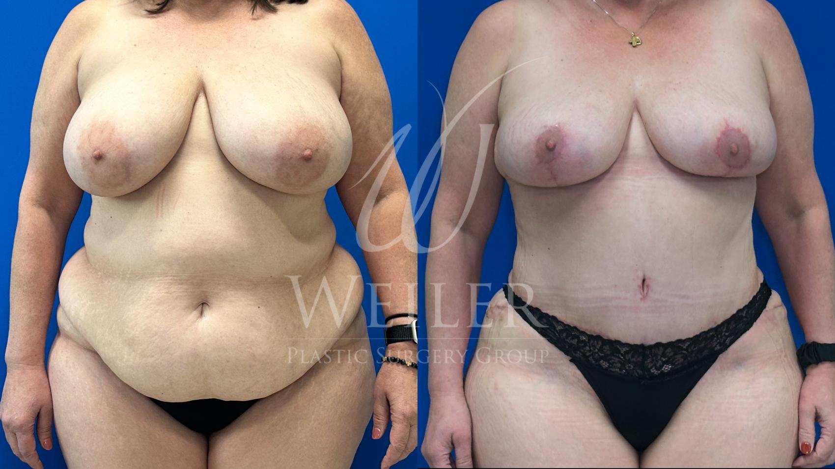 Before & After Breast Reduction Case 1529 Front View in Baton Rouge, New Orleans, & Lafayette, Louisiana