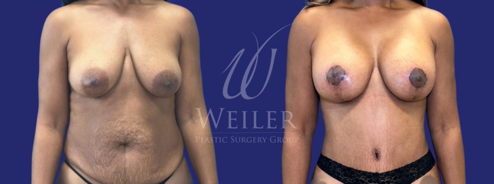 Before & After Breast Lift with Augmentation Case 1530 Front View in Baton Rouge, New Orleans, & Lafayette, Louisiana