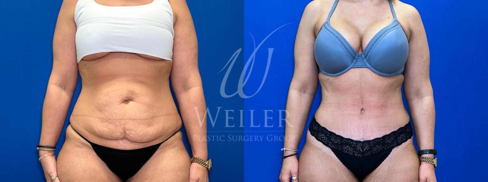 Before & After Tummy Tuck Case 1534 Front View in Baton Rouge, New Orleans, & Lafayette, Louisiana