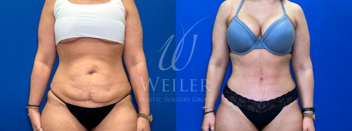 Before & After Tummy Tuck Case 1534 Front View in Baton Rouge, New Orleans, & Lafayette, Louisiana
