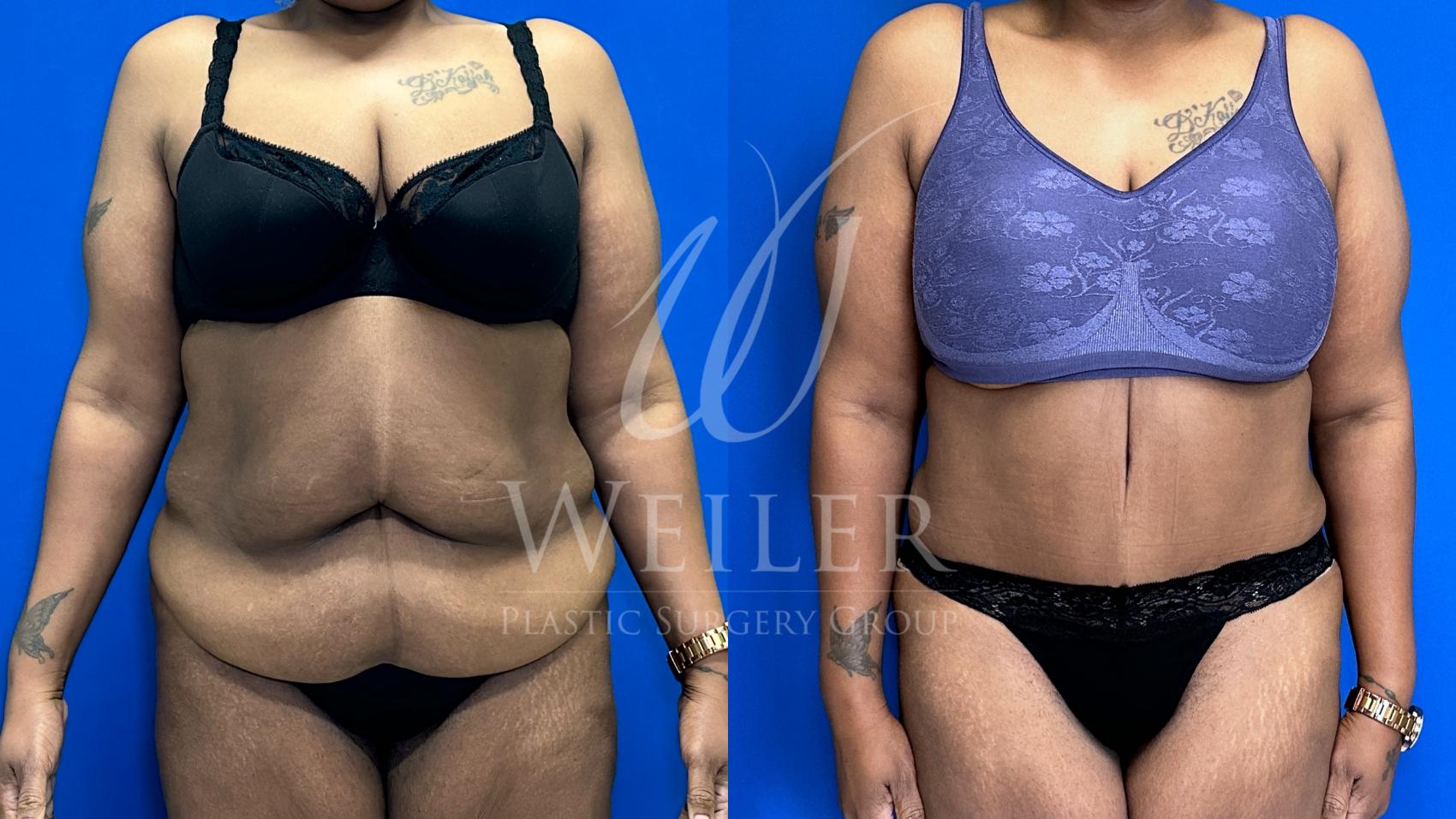 Before & After Tummy Tuck Case 1544 Front View in Baton Rouge, New Orleans, & Lafayette, Louisiana