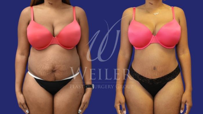 Before & After Tummy Tuck Case 1549 Front View in Baton Rouge, New Orleans, & Lafayette, Louisiana