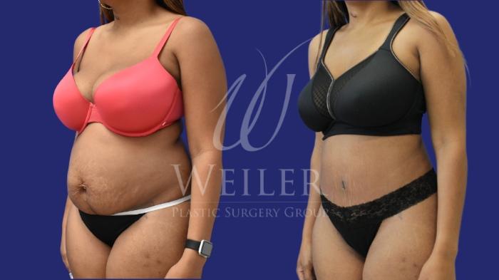 Before & After Tummy Tuck Case 1549 Left Oblique View in Baton Rouge, New Orleans, & Lafayette, Louisiana