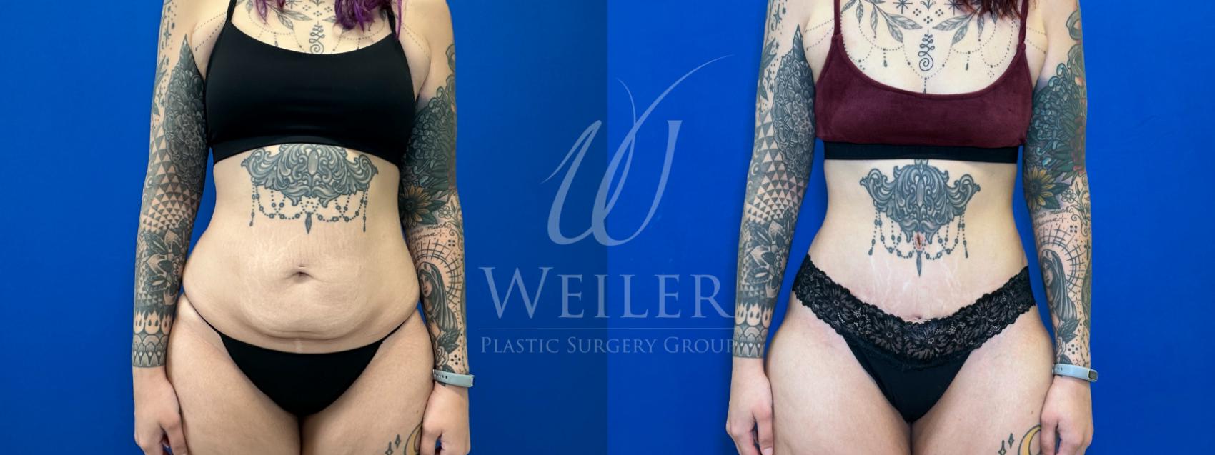 Before & After Tummy Tuck Case 1559 Front View in Baton Rouge, New Orleans, & Lafayette, Louisiana