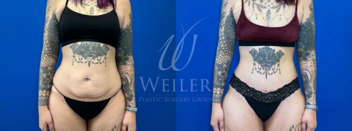 Before & After Tummy Tuck Case 1559 Front View in Baton Rouge, New Orleans, & Lafayette, Louisiana