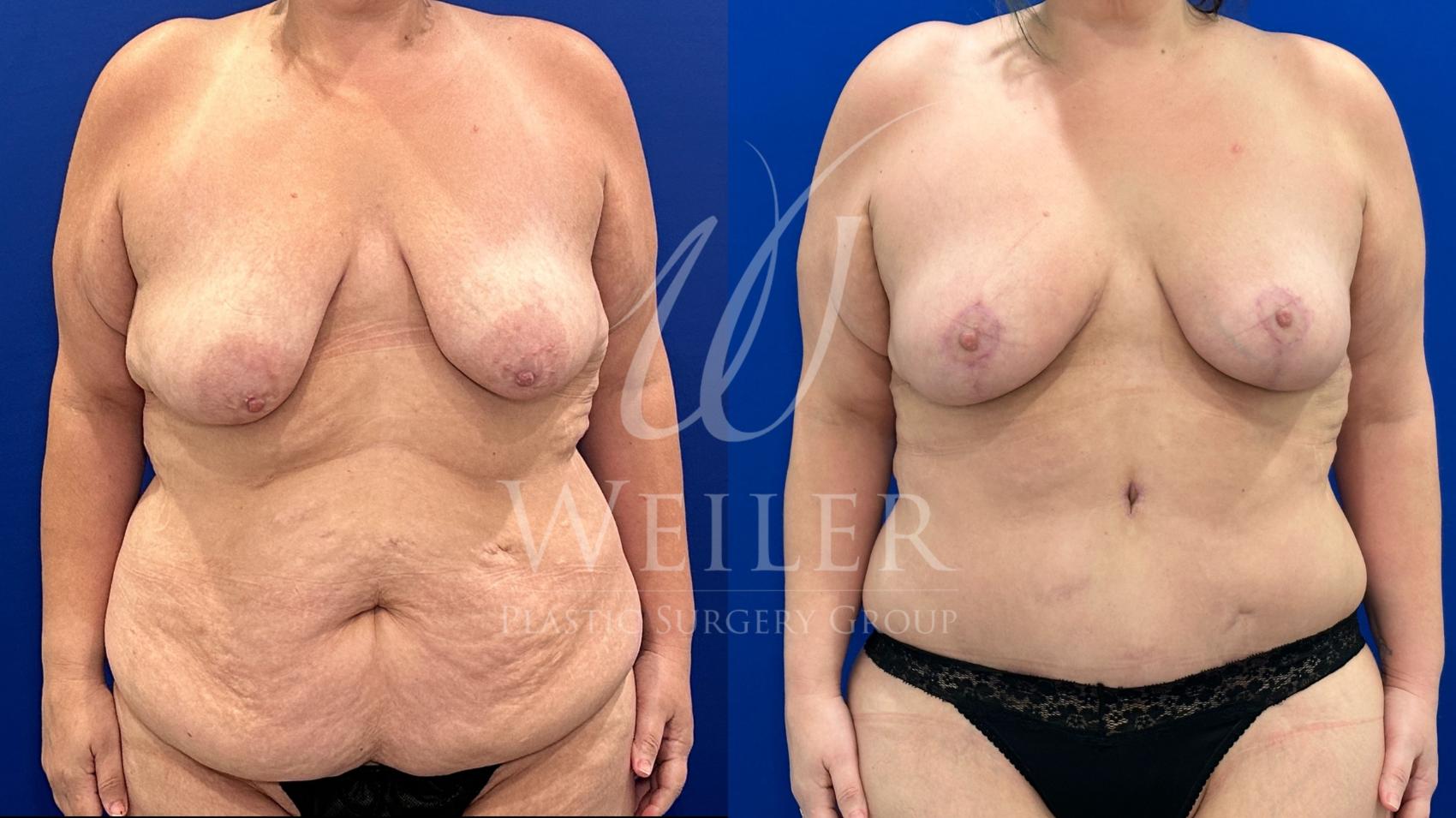 Before & After Tummy Tuck Case 1560 Front View in Baton Rouge, New Orleans, & Lafayette, Louisiana