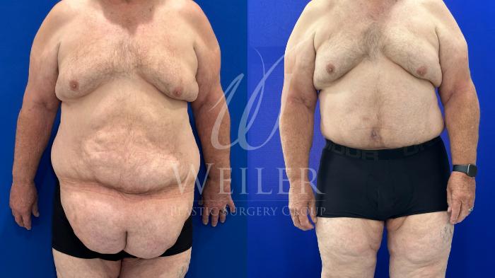 Before & After Tummy Tuck Case 1596 Front View in Baton Rouge, New Orleans, & Lafayette, Louisiana