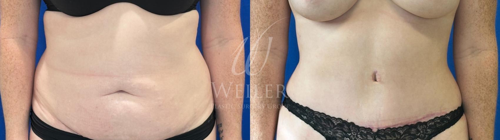 Before & After Tummy Tuck Case 1607 Front View in Baton Rouge, New Orleans, & Lafayette, Louisiana