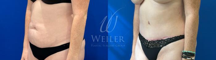 Before & After Tummy Tuck Case 1607 Left Oblique View in Baton Rouge, New Orleans, & Lafayette, Louisiana