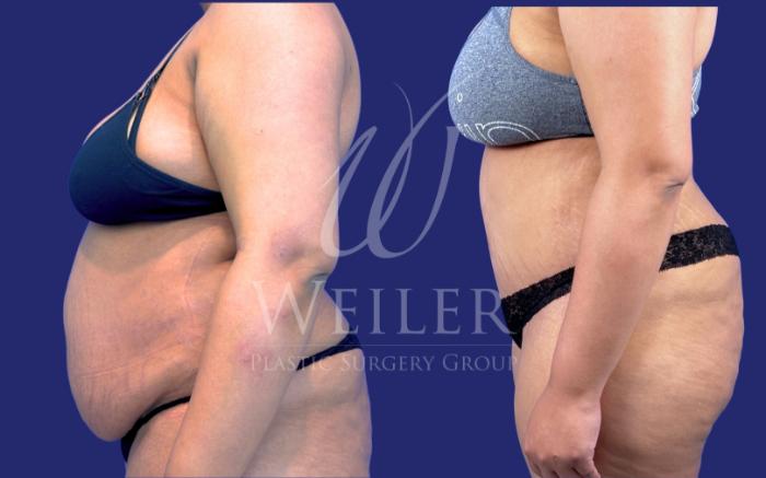 Before & After Tummy Tuck Case 1614 Left Side View in Baton Rouge, New Orleans, & Lafayette, Louisiana