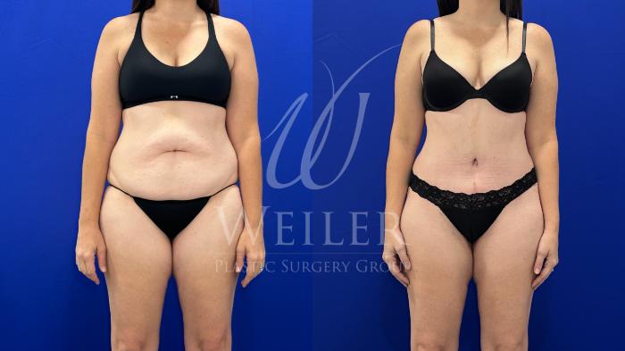 Before & After Tummy Tuck Case 1618 Front View in Baton Rouge, New Orleans, & Lafayette, Louisiana