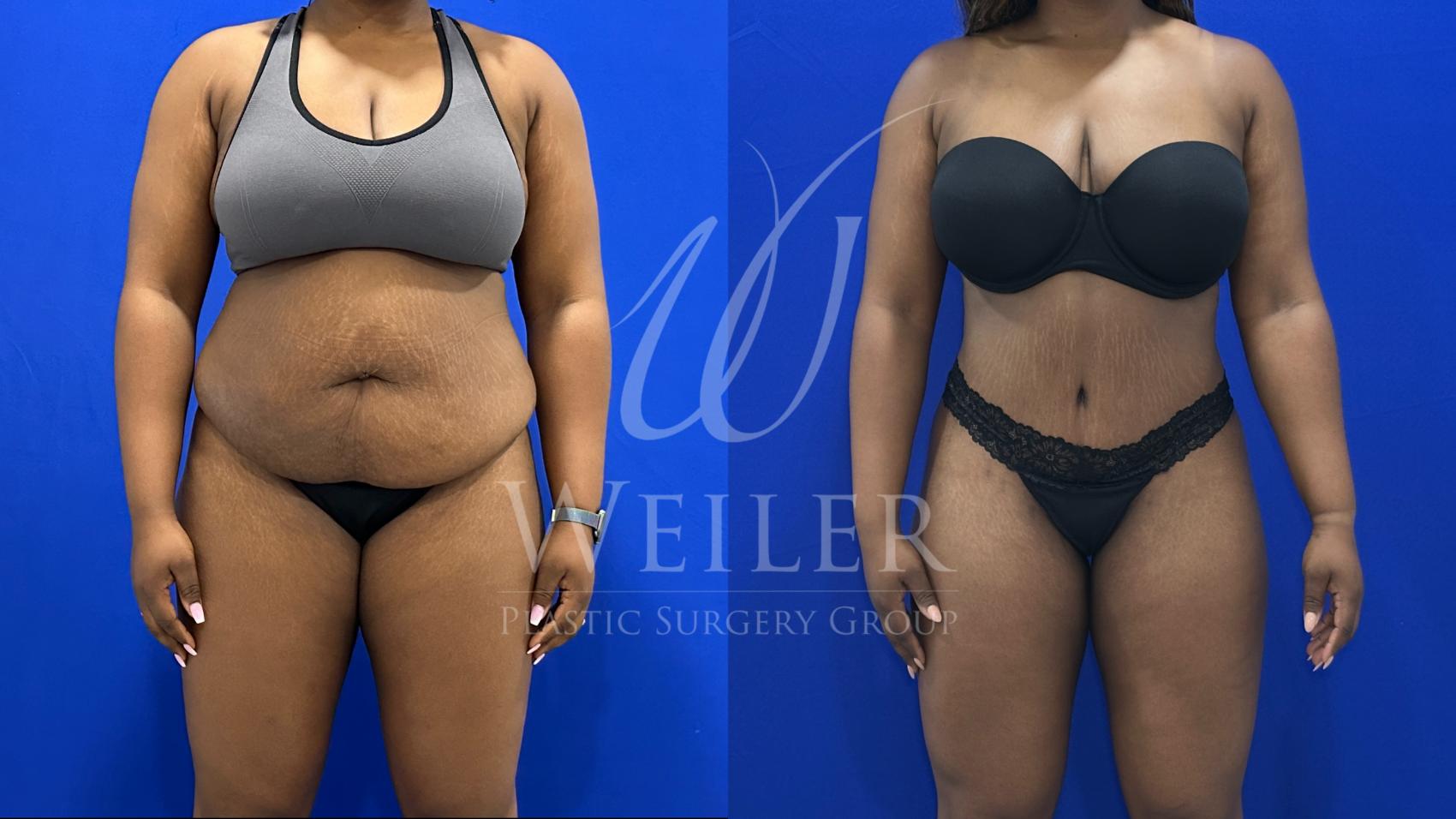 Before & After Tummy Tuck Case 1627 Front View in Baton Rouge, New Orleans, & Lafayette, Louisiana