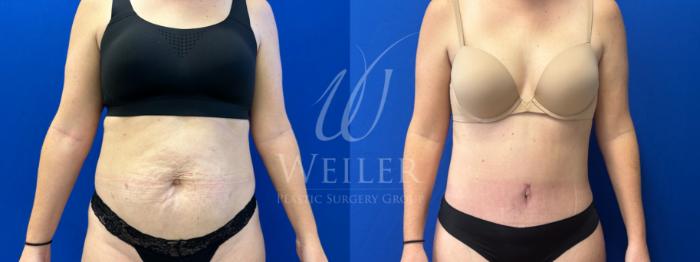 Before & After Tummy Tuck Case 1629 Front View in Baton Rouge, New Orleans, & Lafayette, Louisiana