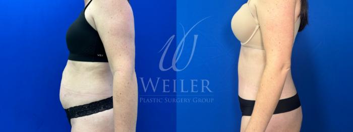 Before & After Tummy Tuck Case 1629 Left Side View in Baton Rouge, New Orleans, & Lafayette, Louisiana