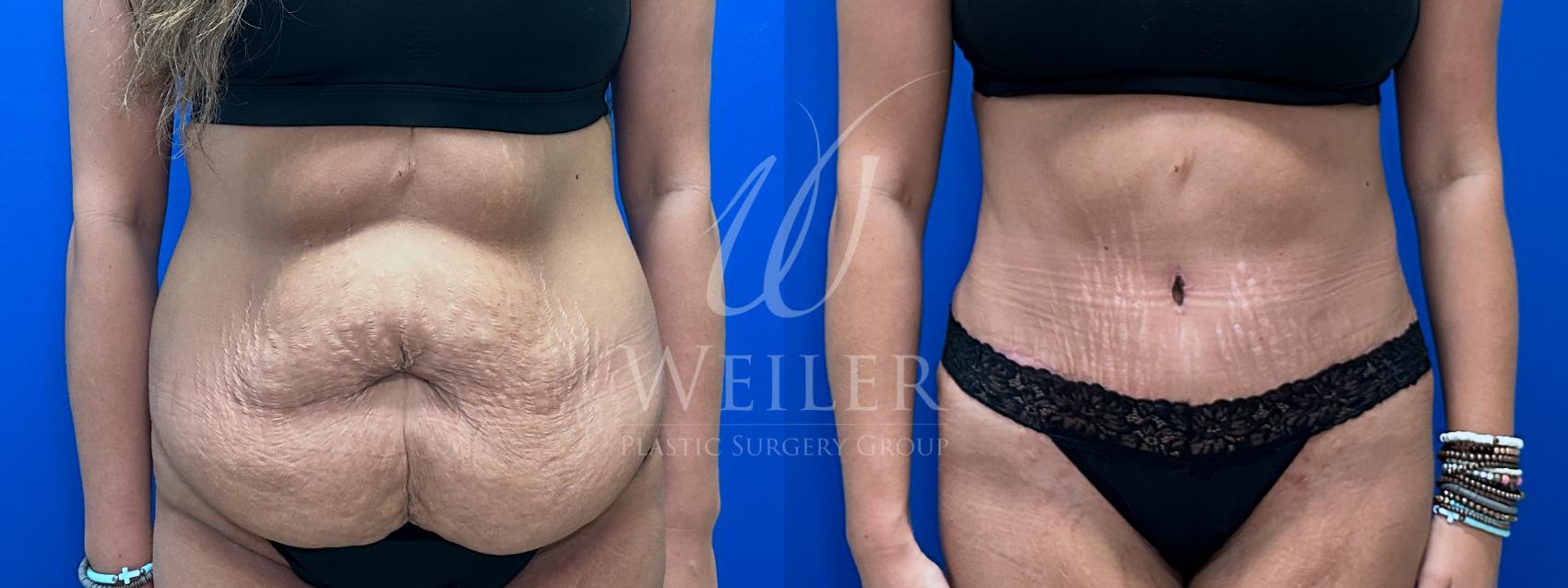 Before & After Tummy Tuck Case 1641 Front View in Baton Rouge, New Orleans, & Lafayette, Louisiana