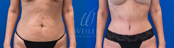 Before & After Tummy Tuck Case 1642 Left Side View in Baton Rouge, New Orleans, & Lafayette, Louisiana
