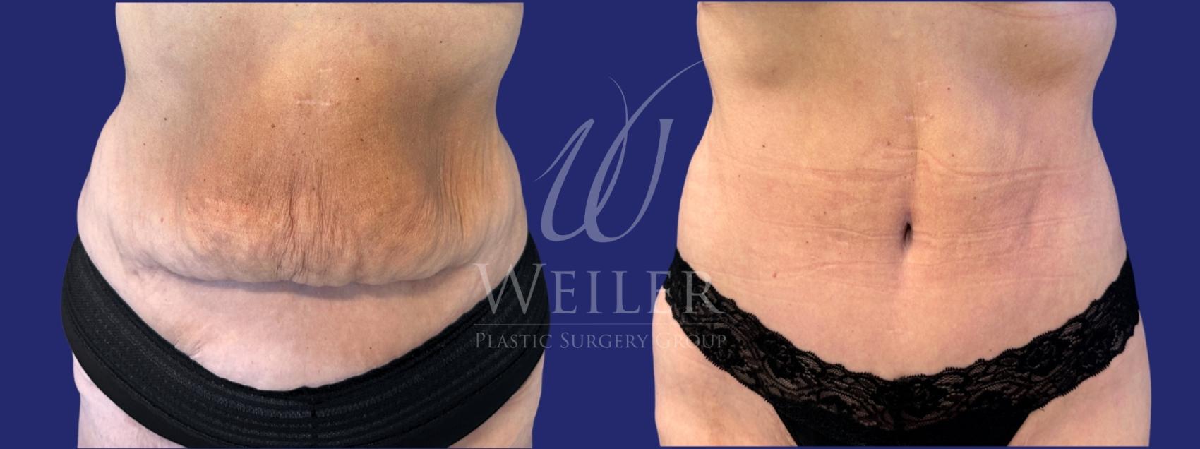 Before & After Tummy Tuck Case 1651 Front View in Baton Rouge, New Orleans, & Lafayette, Louisiana